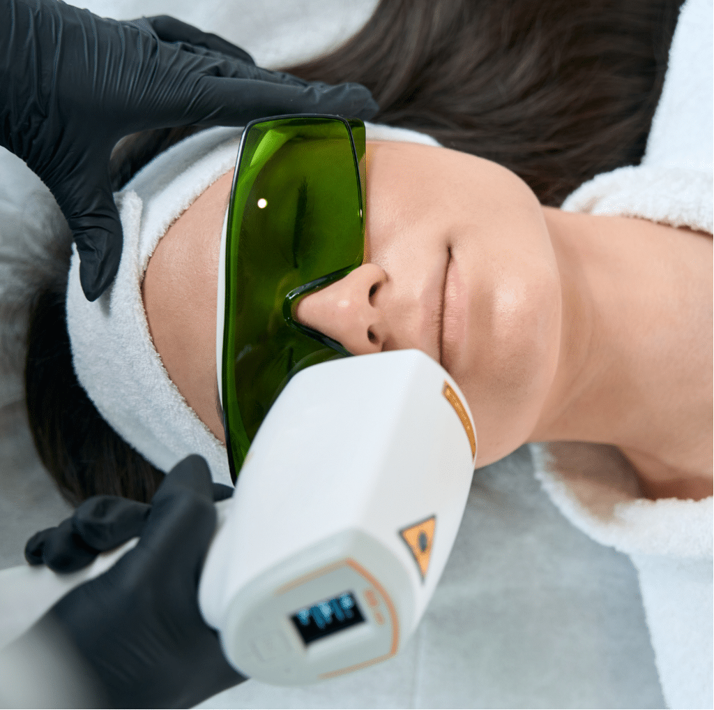 Epilation au laser visage